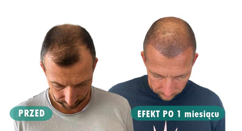 Efekty po przeszczepie włosów w Turcji